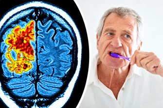 Oral health and Alzheimer’s risk
