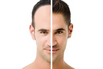 عدوى مروعة بعد زراعة الشعر! + 11 من مضاعفات زراعة الشعر التي لا تعرف عنها شيئاً