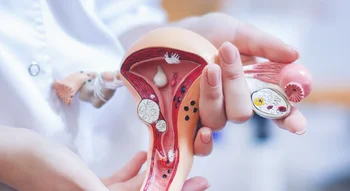 Modèle anatomique de l'utérus montrant des anomalies des trompes.