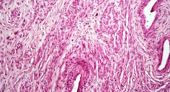 Vue microscopique du fibrome utérin montrant les tissus affectés.