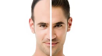 صورة مقارنة قبل وبعد زراعة الشعر لعلاج الصلع الوراثي عند الرجال