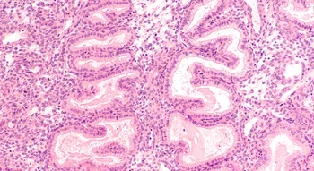 Vue microscopique de l’endomètre, tissu où se développe le polype utérin.